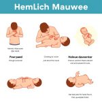 Heimlich Maneuver: Panduan Pertolongan Pertama yang Wajib Diketahui untuk Menyelamatkan Nyawa