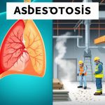 Asbestosis: Pengenalan, Penyebab, Gejala, & Cara Pencegahan di Tempat Kerja