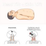 Head Tilt-Chin Lift: Hindari Kesalahan Umum Ini untuk Penyelamatan yang Efektif